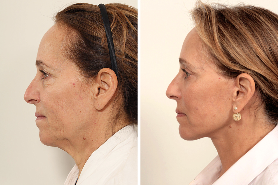 Blepharoplasty case #7923