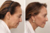 Brow Lift case #7925 slider thumbnail
