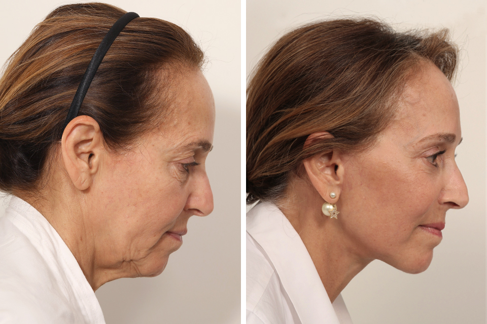 Blepharoplasty case #7923