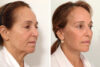 Brow Lift case #7925 slider thumbnail