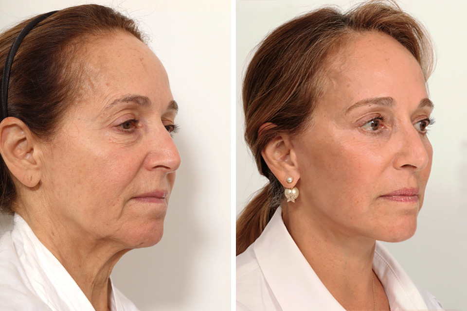 Blepharoplasty case #7923