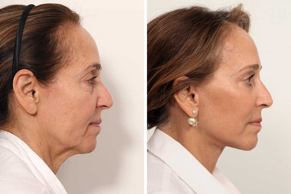 Blepharoplasty case #7923