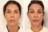 Blepharoplasty case #8190 slider thumbnail