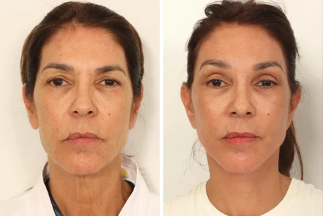 Blepharoplasty case #8190