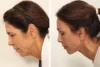 Blepharoplasty case #8190 slider thumbnail