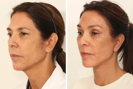 Blepharoplasty case #8190