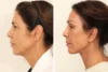 Blepharoplasty case #8190 slider thumbnail