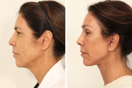Blepharoplasty case #8190