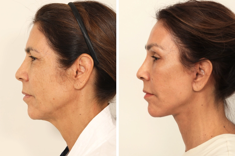 Blepharoplasty case #8190