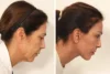 Blepharoplasty case #8190 slider thumbnail