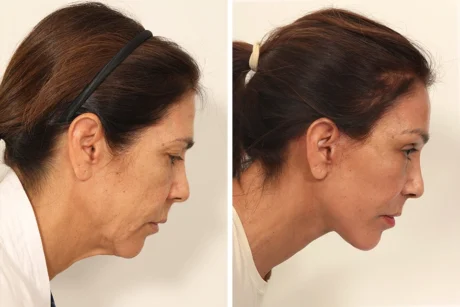 Blepharoplasty case #8190