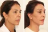 Blepharoplasty case #8190 slider thumbnail