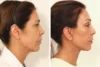 Blepharoplasty case #8190 slider thumbnail