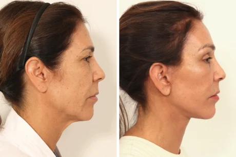 Blepharoplasty case #8190